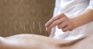 المعالجة بوخز الإبر(Acupuncture)
